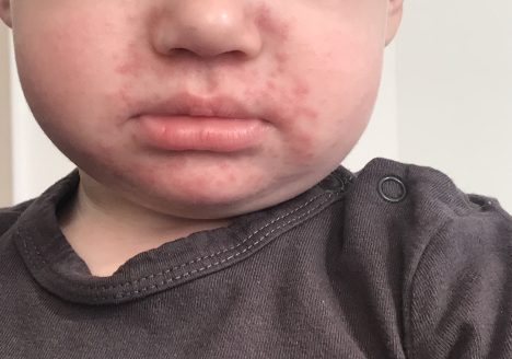 Zapalenie okołoustne