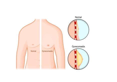 Ginekomastia leczenie