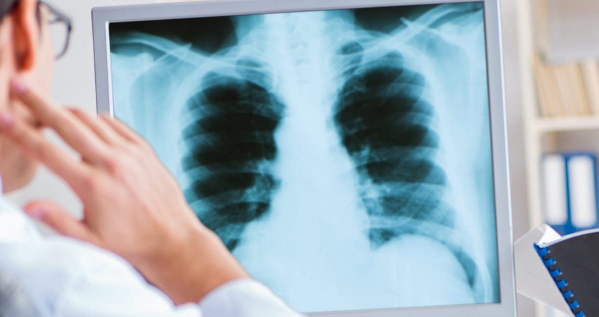 Lung cancer symptoms